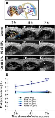 Endolymphatic Hydrops is a Marker of Synaptopathy Following Traumatic Noise Exposure